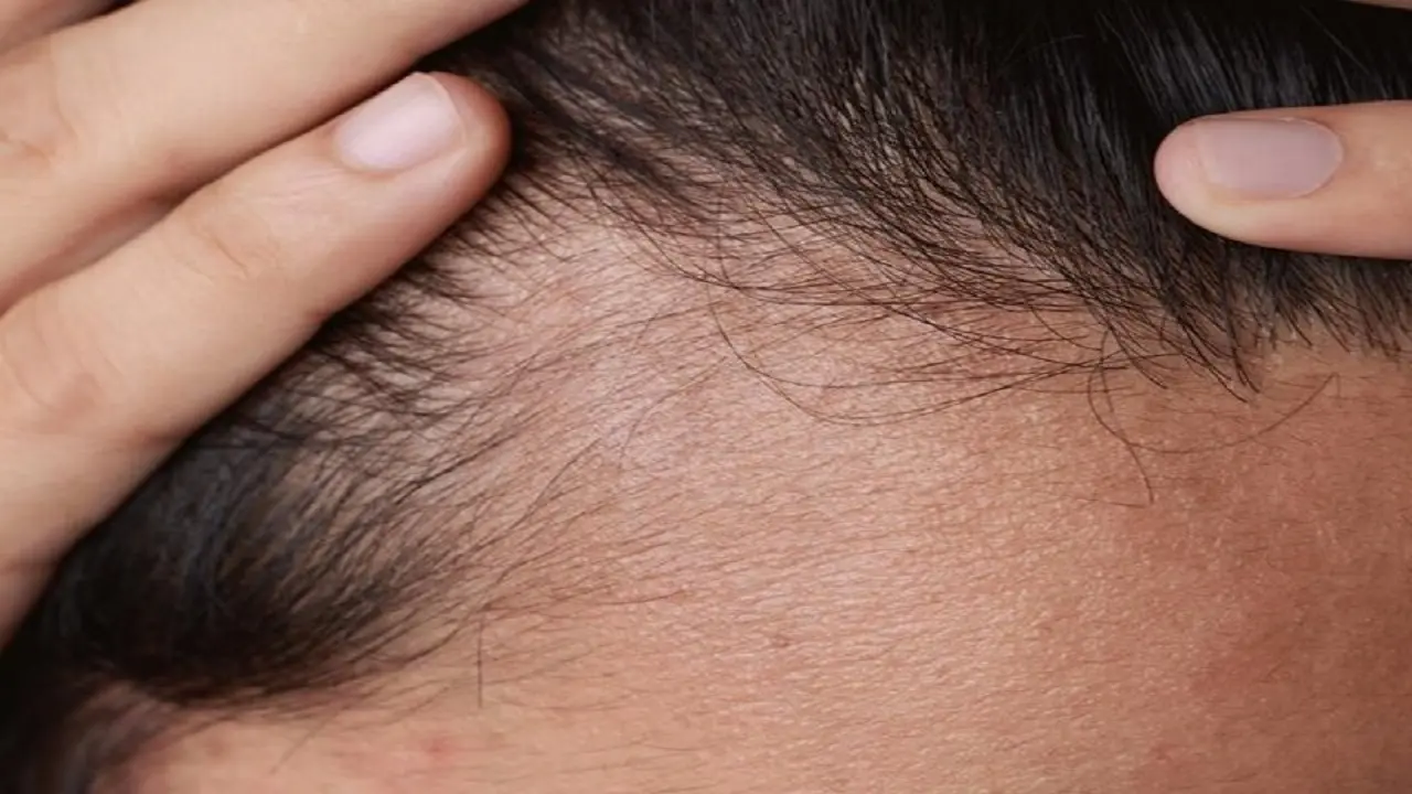 ۶ دلیل که سبب ریزش موها می‌شوند