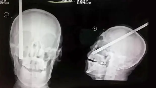 خارج کردن میله آهنی از مغز پسر ۲۴ ساله| مجروح زنده ماند!