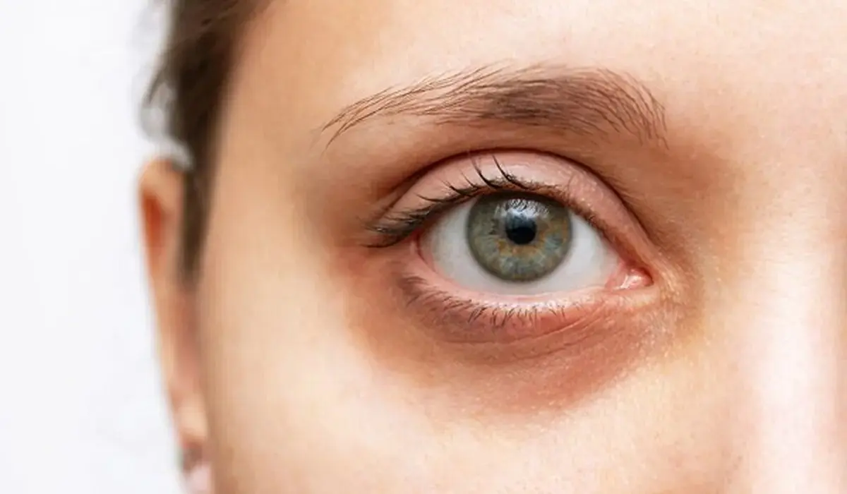 سیاهی زیر چشم، یکی از شایع‌ترین حالت‌های ظاهری پوست اطراف چشم است که...