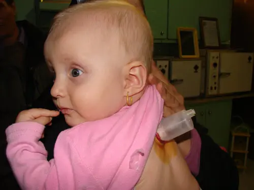 هشدار! حجامت نوزاد برای درمان زردی عوارض مرگبار دارد