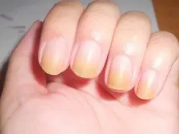 سندرم ناخن زرد (Yellow Nail Syndrome) یک بیماری نادر است که ناخن‌های دست...