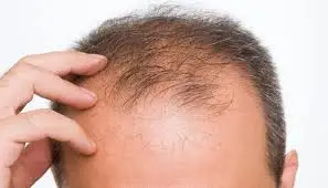 کشف جدیدی برای جلوگیری از ریزش مو