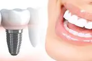 ایمپلنت آلمانی بهتره یا کره ای