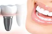 ایمپلنت آلمانی بهتره یا کره ای