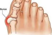 علل شست کج چیست؟