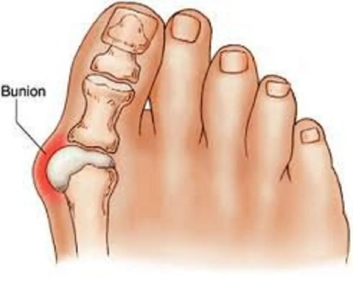 علل شست کج چیست؟