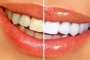 با این روش معجزه آسا دندان های خود را سفید کنید!