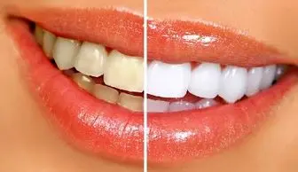 با این روش معجزه آسا دندان های خود را سفید کنید!