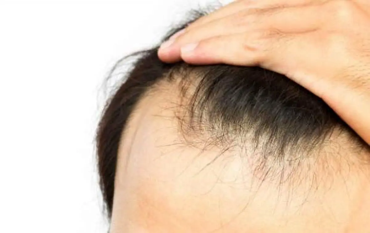 دلایل ریزش موی سر چیست؟
