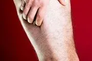 سیاتیک چیست و چه علائمی دارد؟