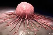 آمار متفاوت نرخ مرگ و میر سرطان سینه در جهان
