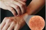 علت دقیق خارش پوست بدن