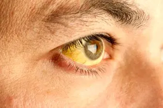 لکه‌های زرد چشم نشانه چیست؟