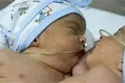 ۲قلوهای بهم چسبیده زرندی ازهم جدا شدند