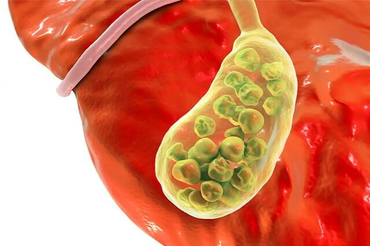 پیشگیری ساده از سنگ کیسه صفرا