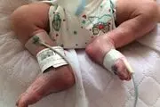 توضیحاتی در مورد ترخیص نوزادی که دچار سوختگی شده بود