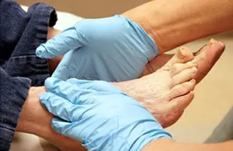 10 نشانه در پاها که خبر از بیماری می دهند