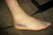 تورم مچ پا نشانه هشدار این بیماری جدی است!