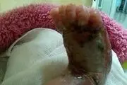 توضیحات یک مسئول درباره نوزادی که پایش سوخت