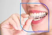 قالب‌گیری سنتی یا دیجیتال؟