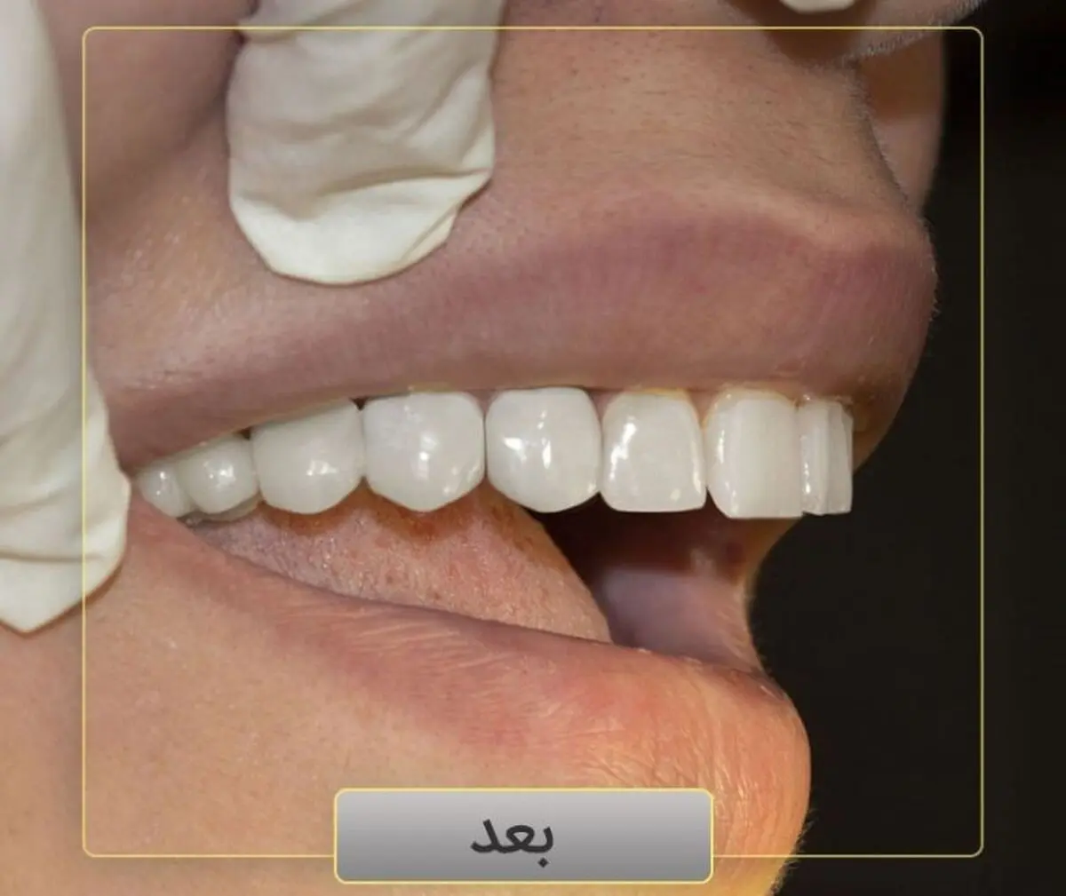 کاشت دندان در یک دقیقه با ایمپلنت فوری

