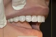 کاشت دندان در یک دقیقه با ایمپلنت فوری

