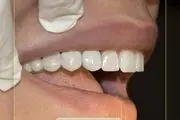 کاشت دندان در یک دقیقه با ایمپلنت فوری

