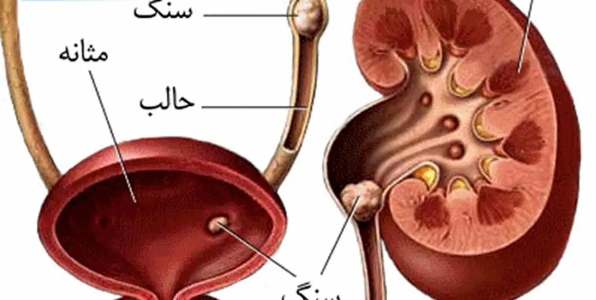 نشانههای ایجاد «سنگ مثانه» چیست؟