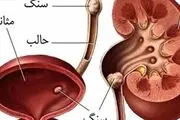 نشانه‌های ایجاد «سنگ مثانه» چیست؟
