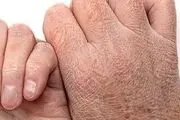 طول درمان اگزما چه مدت است؟
