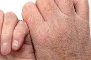 طول درمان اگزما چه مدت است؟
