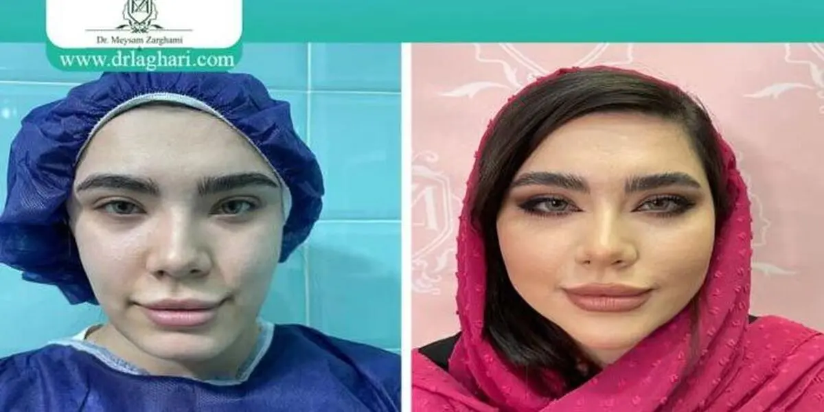 ماندگاری تزریق چربی به صورت چقدر است؟


