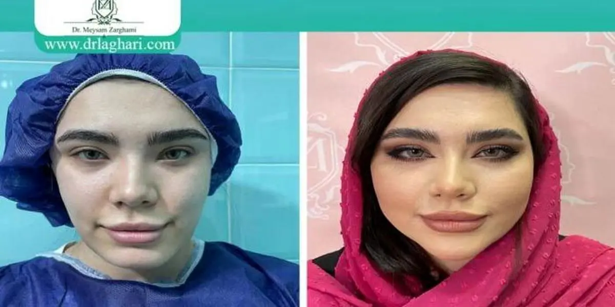 ماندگاری تزریق چربی به صورت چقدر است؟