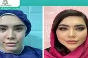 ماندگاری تزریق چربی به صورت چقدر است؟

