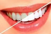 سفیدکننده‌های دندان را با احتیاط مصرف کنید 