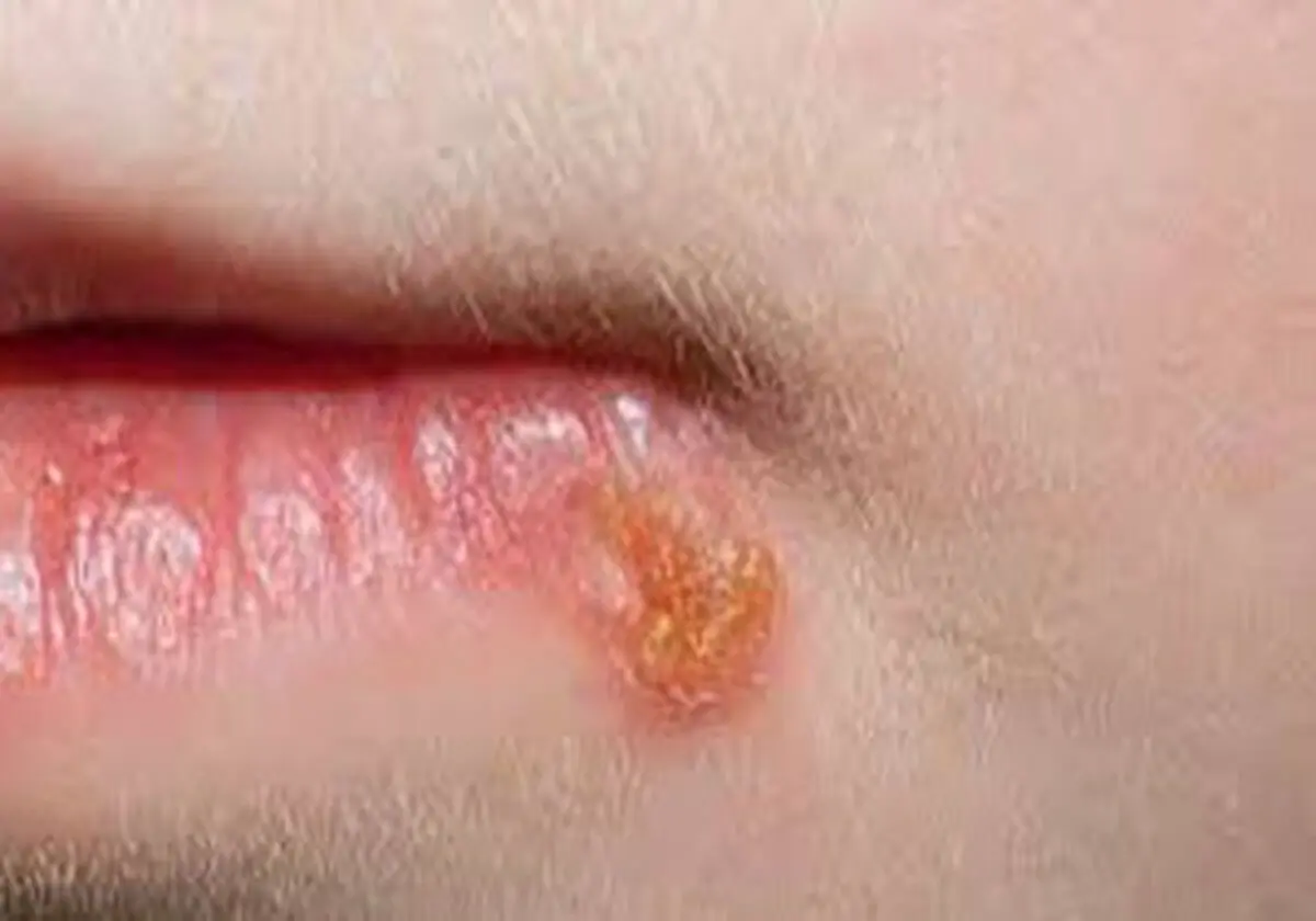 ۱۳ درمان خانگی برای پیشگیری و درمان تبخال