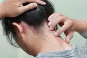 بیماری جذام یا خوره چیست و آیا جذام درمان دارد؟