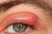 گل مژه چشم با چشمانتان چه می‌کند؟