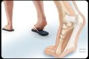 معایب پوشیدن صندل های تابستانی را بشناسید