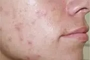 راهکارهای درمان فوری جوش‌های صورت
