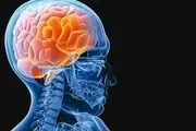نشانه های سکته مغزی در زنان چیست؟