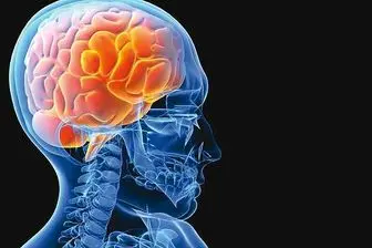 هر 3 دقیقه یک نفر مبتلا به سکته مغزی می‌شود!