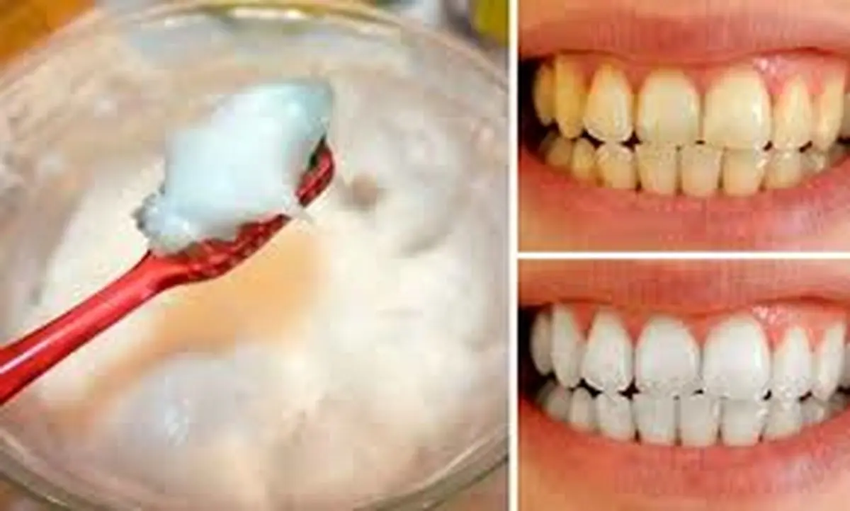 روش جرمگیری دندان در خانه+ آموزش کامل