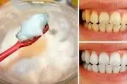 
روش جرم‌گیری دندان در خانه+ آموزش کامل