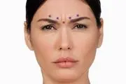 بوتاکس خط اخم  پیشانی: روشی سریع و موثر برای داشتن چهره ای جوانتر