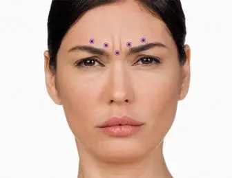 بوتاکس خط اخم  پیشانی: روشی سریع و موثر برای داشتن چهره ای جوانتر