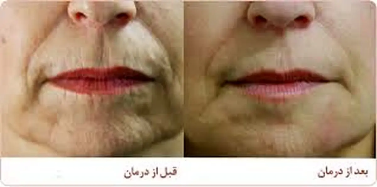 روشهای جلوگیری از چروک لب