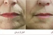 روش‌های جلوگیری از چروک لب

