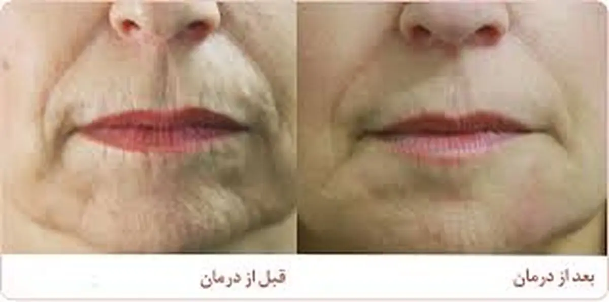 روش‌های جلوگیری از چروک لب
