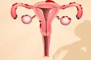 آیا آندومتریوز موجب نازایی زنان می‌شود؟
